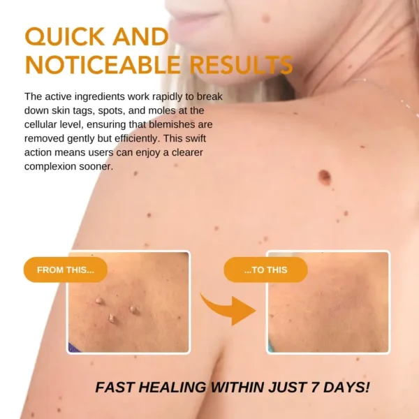 Fivfivgo™ Skin Tags, Spots & Mole Remover