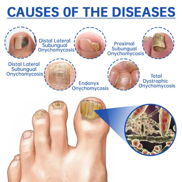 Furzero™ Advanced PureNail Fungus Laser Device