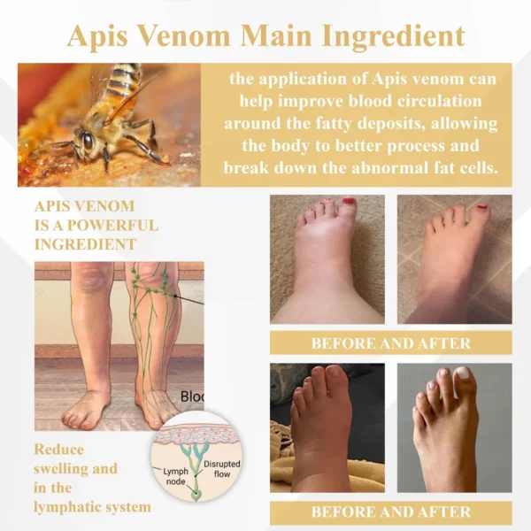 EdemaCare™ Apis Venom DetoxCream