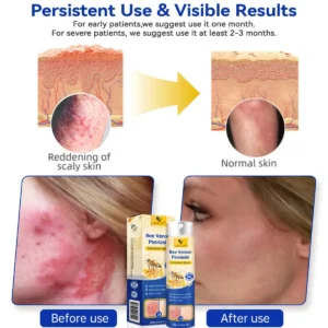 LOVILDS™PsoriaHeal psoriasis Spray