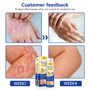 LOVILDS™PsoriaHeal psoriasis Spray