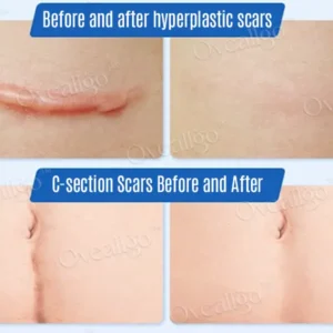 Oveallgo™ Silicone Anti-Scar Cream