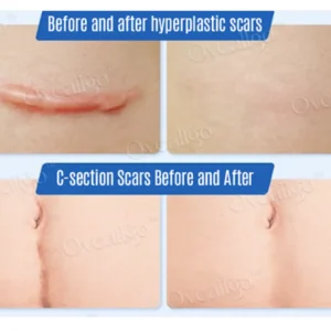 Oveallgo™ SilkScar Scar Treatment & Skin Repair Serum