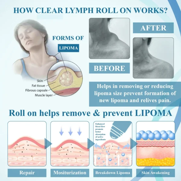 Lovilds™ LumpsClear Lymph Say Goodbye to Lipomas and Swelling